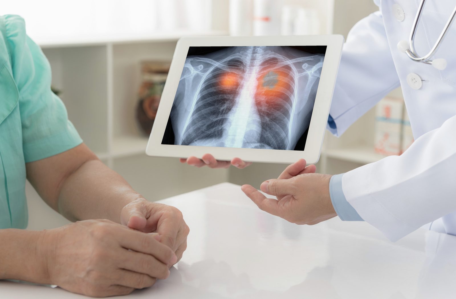 Revisión del expediente clínico de cáncer de pulmón de células no pequeñas